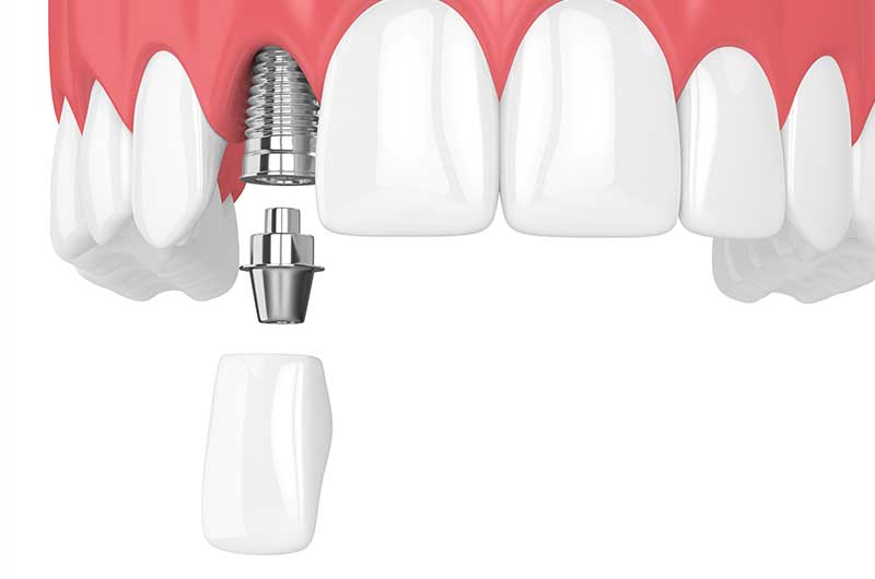 Dental Implants