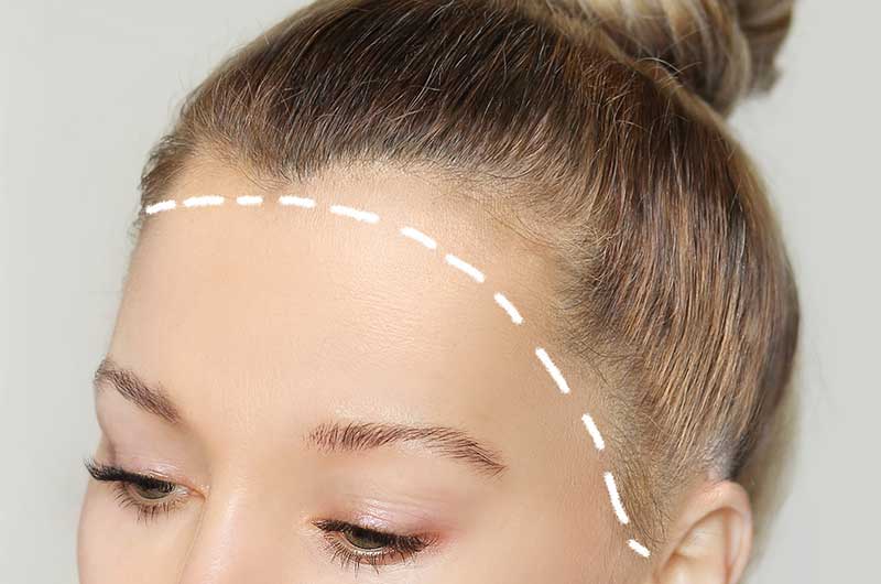 Hair Transplant for Women