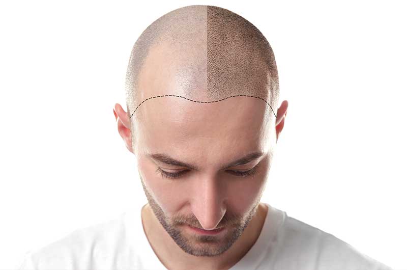 Hair transplant