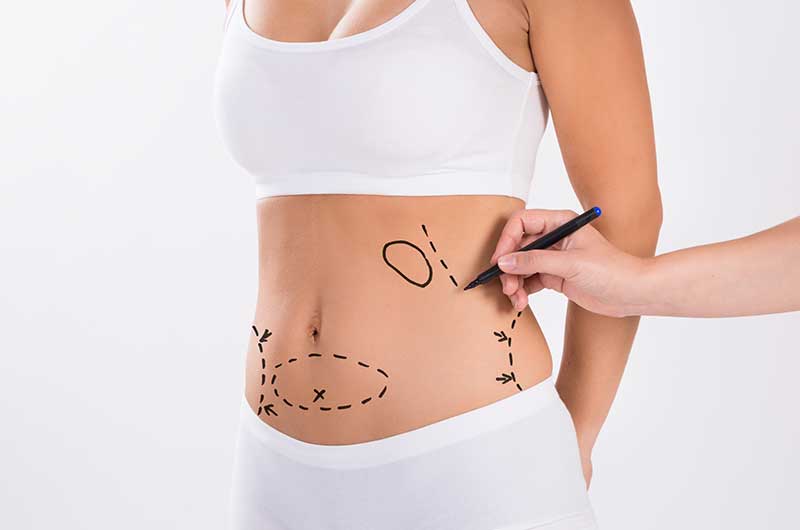 Liposuction