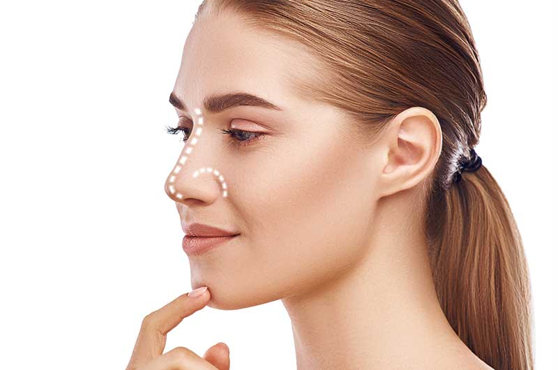 Rhinoplasty