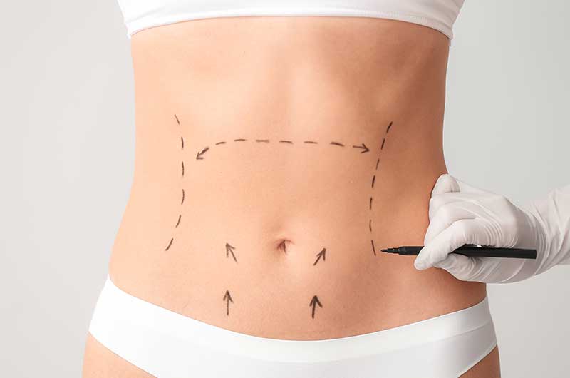Abdominoplasty