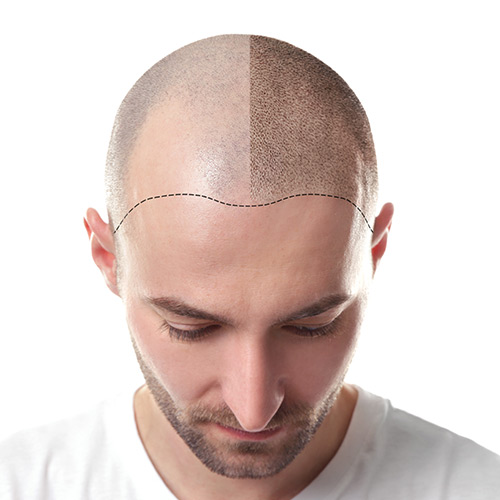 Hair Transplant